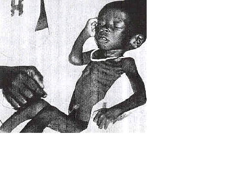 Child with Marasmus and Tuberculosis.PNG