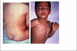 Measles.jpg