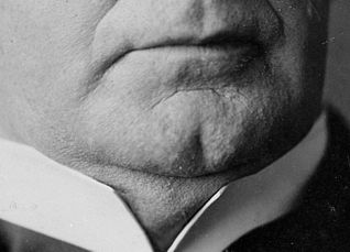 Picture of a cleft chin