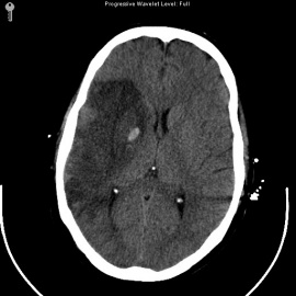 Stroke/Assessment Tools - WikiEducator