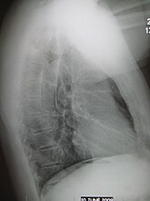 Normal lateral chest x-ray.jpg